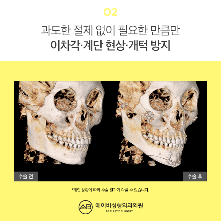 사각턱수술후기 기대가 되지 관련 이미지 3