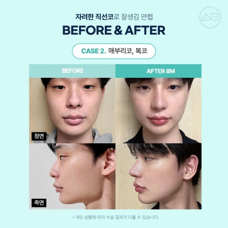 남자직선코성형 왜 에이비성형외과일까? 관련 이미지 11