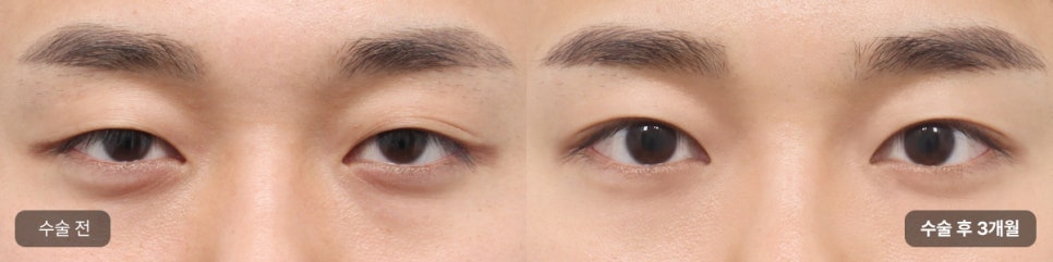 Key Points of Male Eye Surgery, Explained by AB! (Feat. Director Son Ji-hwan) image 3