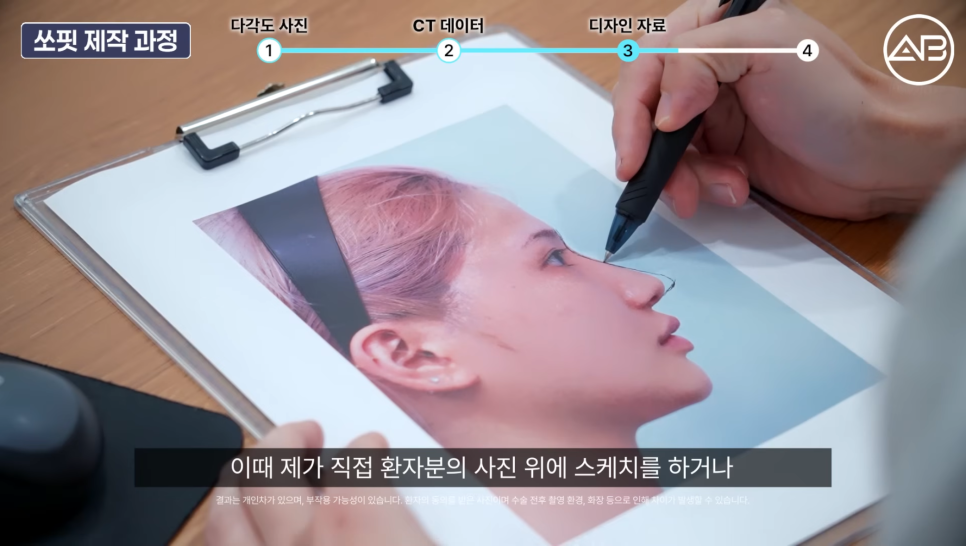 에이비성형외과 맞춤보형물 쏘핏 보형물이 중요한 이유 관련 이미지 4