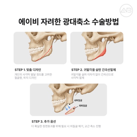 자연스럽고 조화로운 자려한안면윤곽을 원한다면 AB성형외과 관련 이미지 8