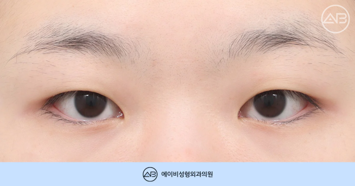 에이비성형외과 무쌍 여자 눈매교정 쌍꺼풀 수술 체크포인트 관련 이미지 1
