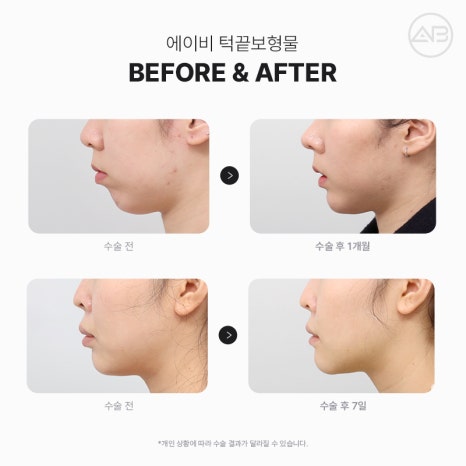 무턱성형 고려하고 있다면 AB성형외과 관련 이미지 6
