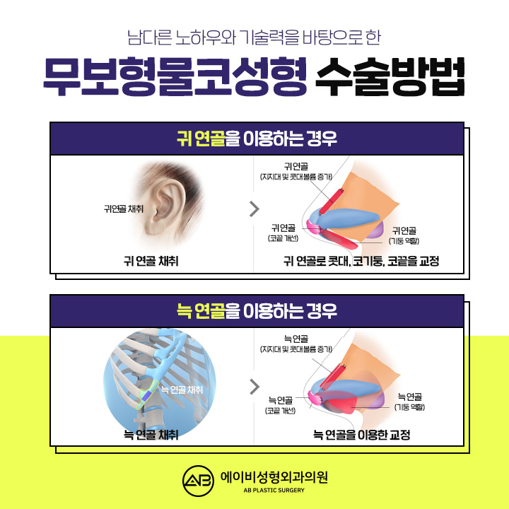 무보형물코수술 선택하고 싶다면 관련 이미지 4