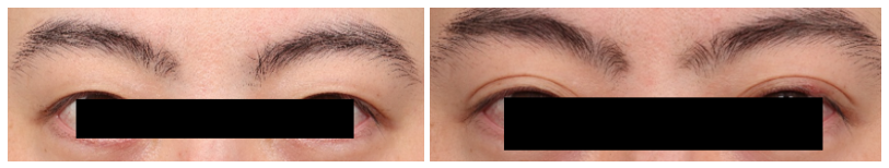 [Column] Can Sunken Eyelids Be Improved Too? image 6
