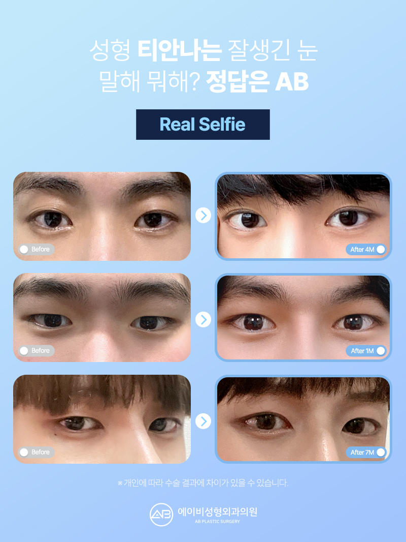 남자눈매교정 잘하는 에이비성형외과 다른점은 뭘까? 관련 이미지 3