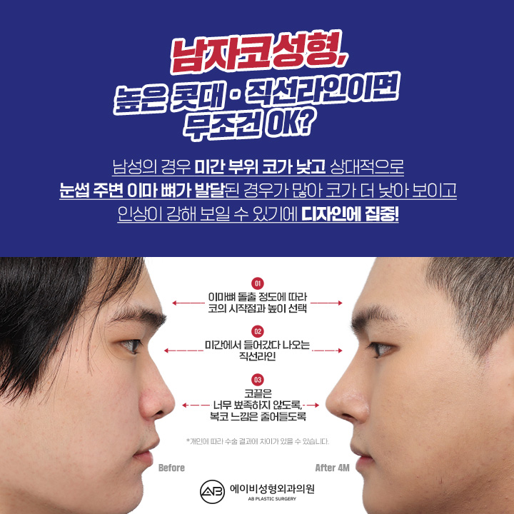 남자코성형후기 라면 여기지 관련 이미지 2