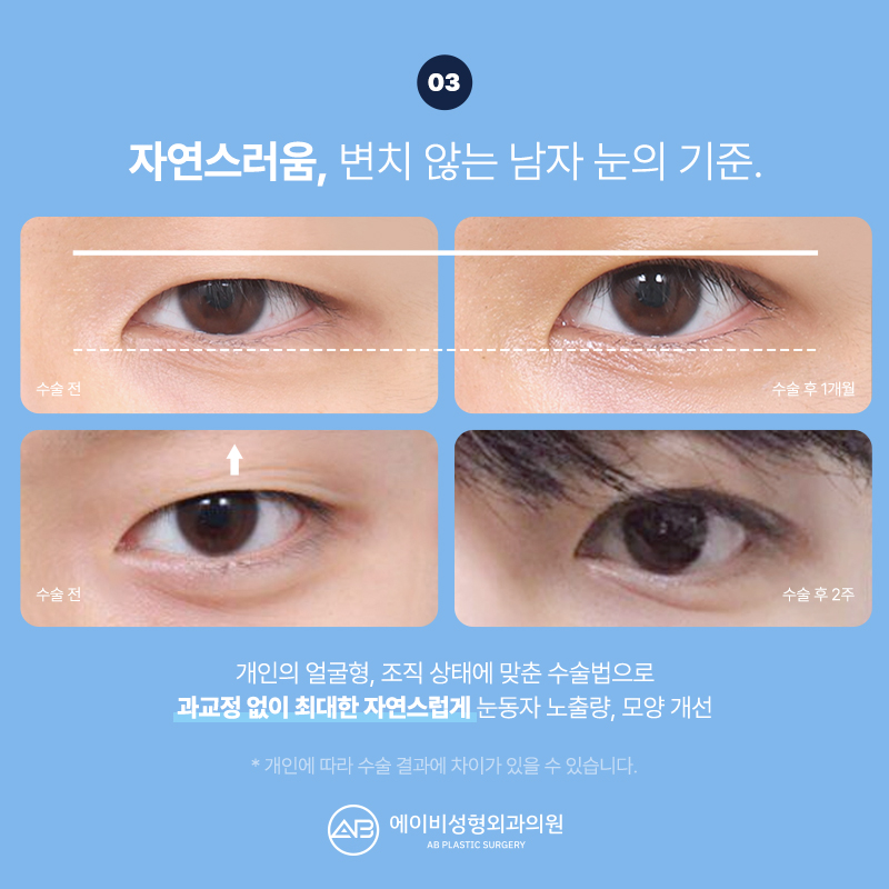 남자눈매교정 잘하는 에이비성형외과 다른점은 뭘까? 관련 이미지 8
