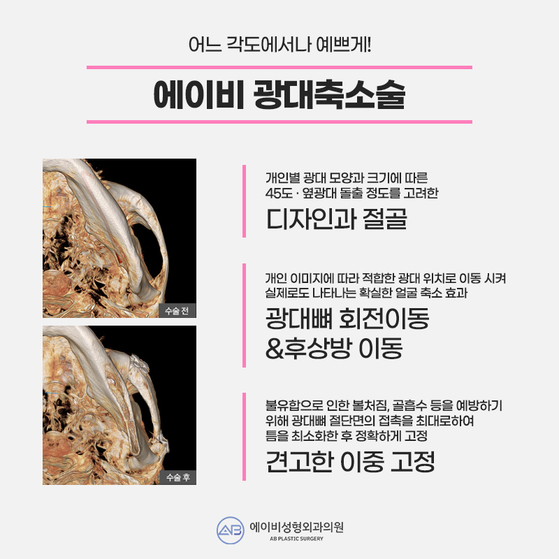 안면윤곽3종수술 솔루션은 에이비! 관련 이미지 2