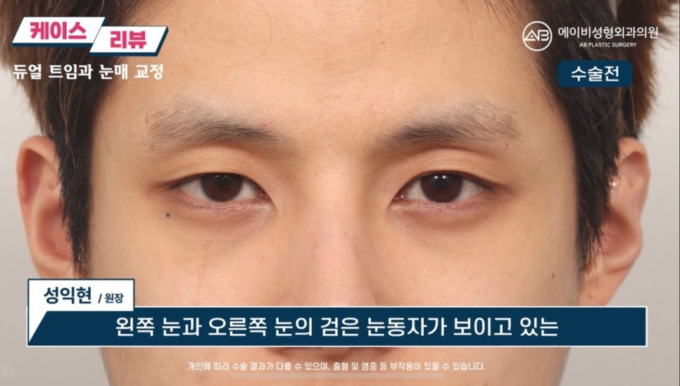#에이비성형외과#에이비tv#눈성형#남자눈성형 관련 이미지 1