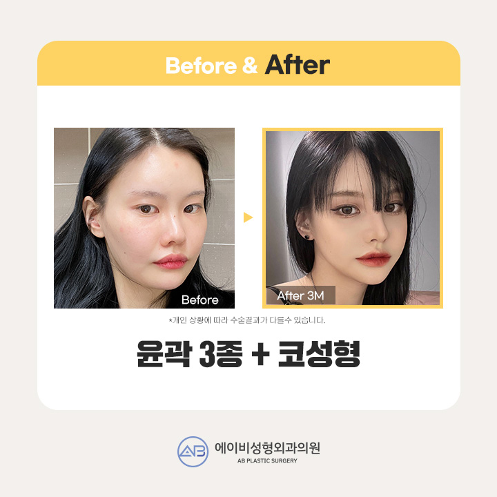 쌍꺼풀수술가격 꼼꼼하게 비교하기 관련 이미지 5