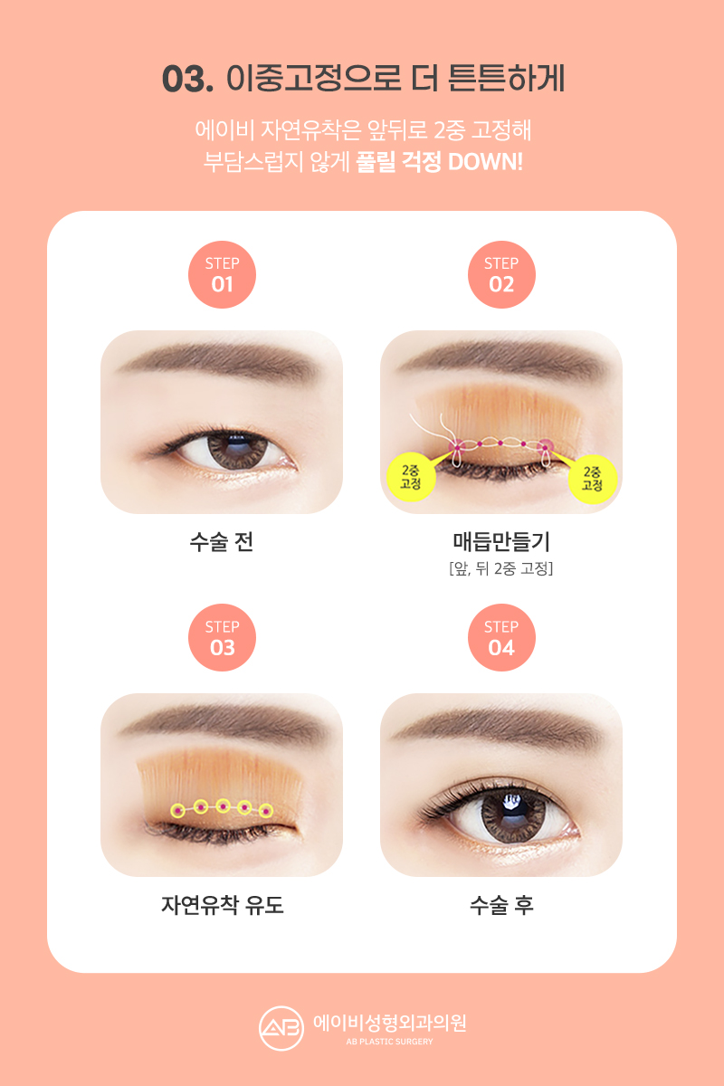 요즘 대세 세미아웃 눈성형 성공하려면? 관련 이미지 7