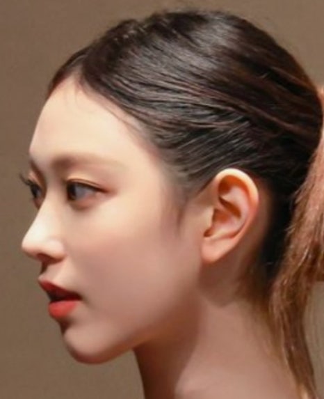 Q. I don’t have much of a nasal bridge, but I want to have only the tip of my nose operated on without an implant. Is that possible? If I have surgery without an implant, how is it performed? image 2