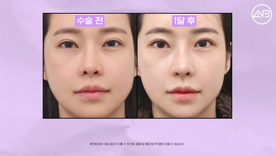 #AB Plastic Surgery #AB TV #Case Review #Nose Surgery #Revision Rhinoplasty image 7