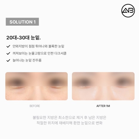 AB Plastic Surgery Under-Eye Fat Repositioning: Effects on Dark Circles and Hollow Under-Eyes, Before-and-After Results, and Side Effects image 8