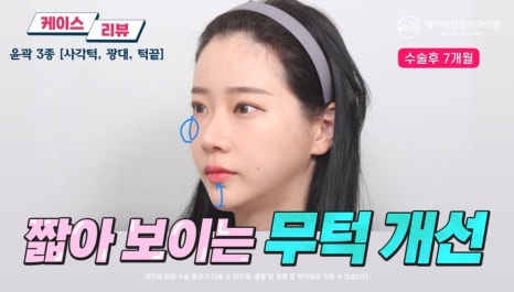 #에이비성형외과#에이비tv#케이스리뷰#윤곽3종수술 관련 이미지 5