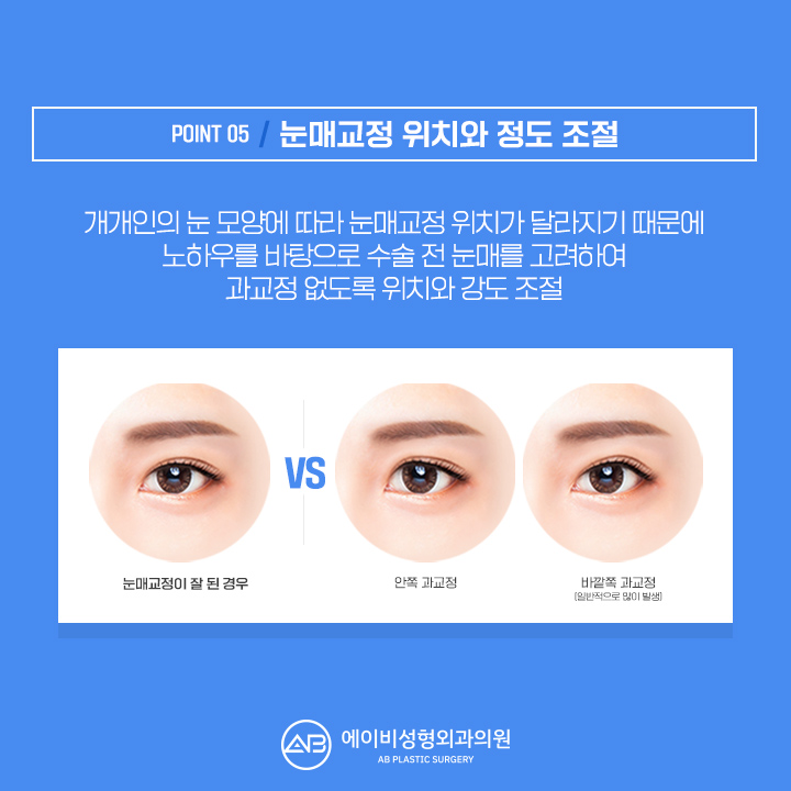 남자눈성형잘하는곳 에이비 라며? 관련 이미지 6