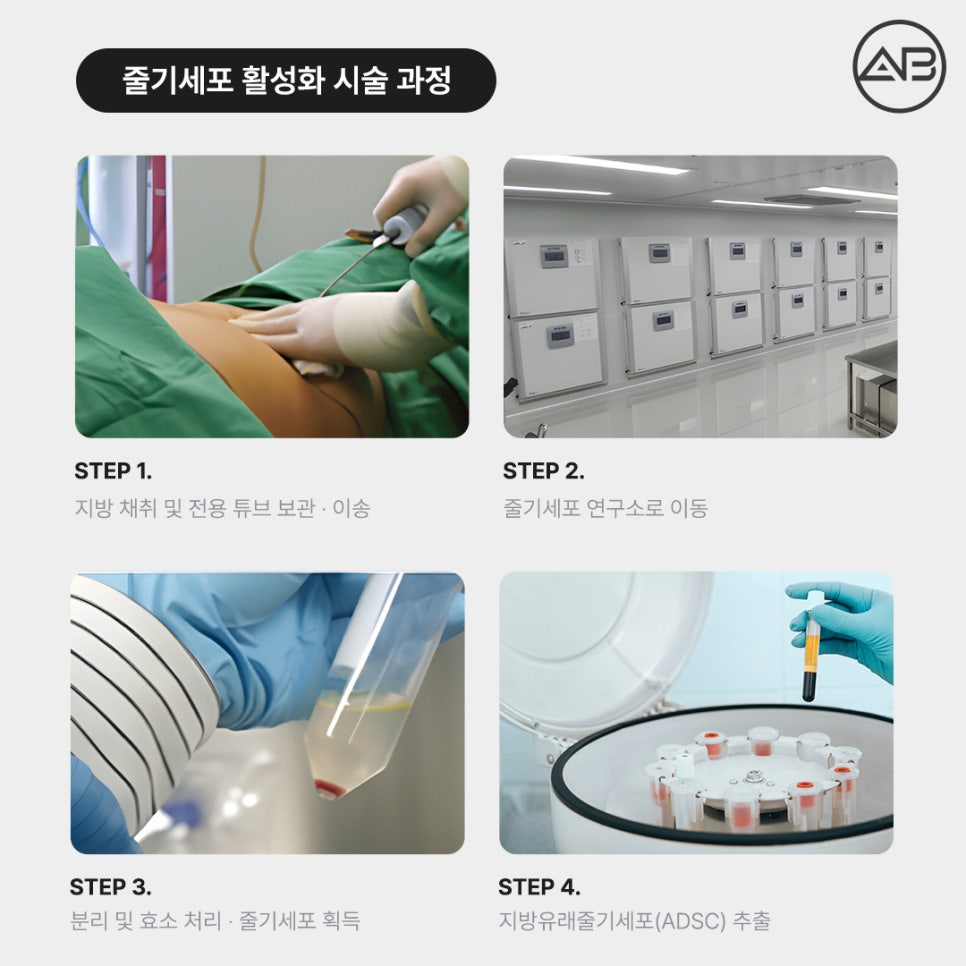 에이비성형외과 활성화줄기세포 안티에이징 안전성 종류 재생 효과 관련 이미지 3