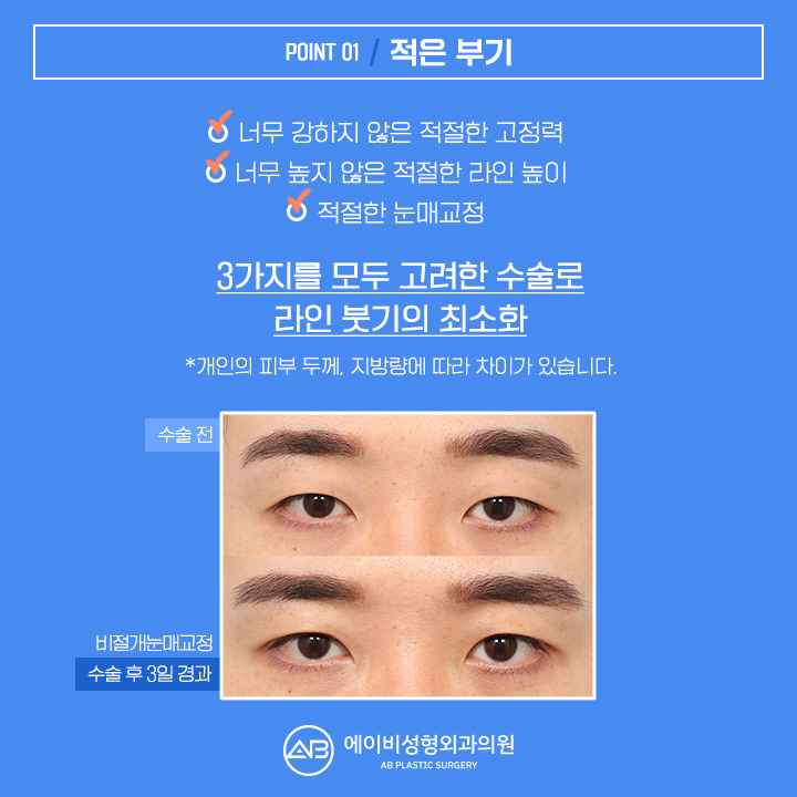 남자눈성형잘하는곳 에이비 라며? 관련 이미지 2