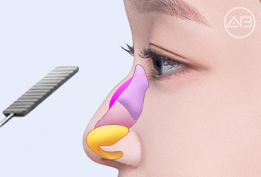 Learn About and Decide on AB Plastic Surgery’s Hump Nose Correction and Implant-Free Rhinoplasty image 3