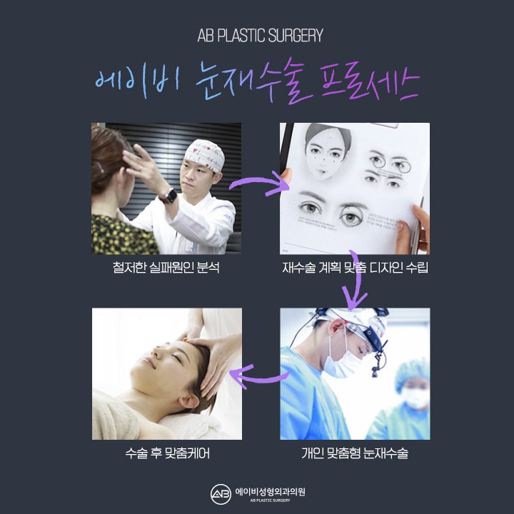 눈재수술비용 얼마인지 궁금해? 관련 이미지 5