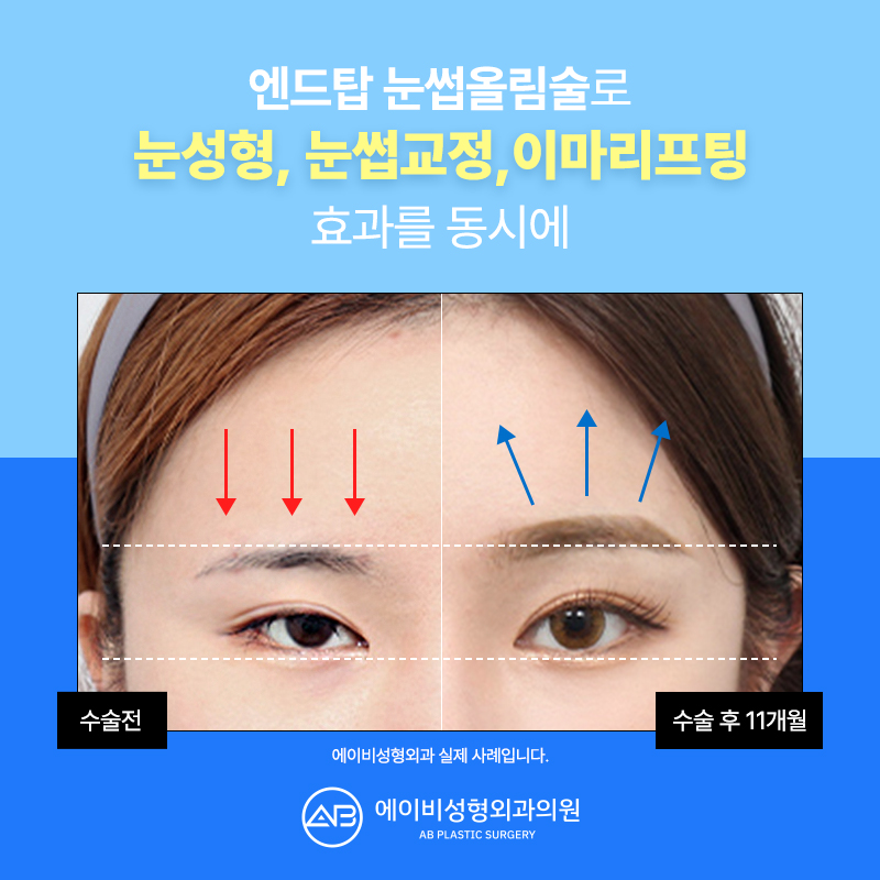 Curious About AB Plastic Surgery’s Brow Lift Surgery? image 2
