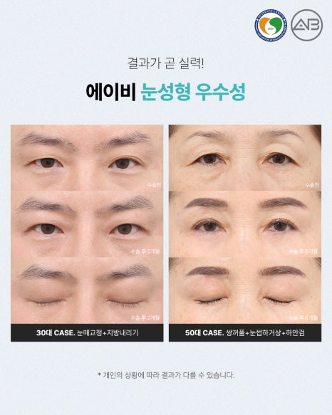 에이비성형외과 눈성형연구회에서 관련 이미지 8