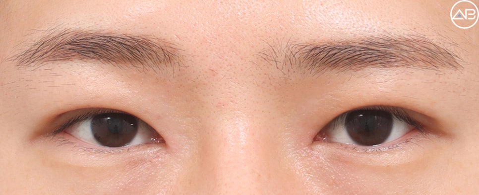 AB Plastic Surgery Male Eye Surgery Case Review (Feat. Director Ahn Moon-young) image 4