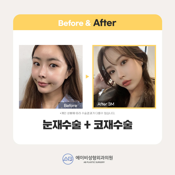 쌍꺼풀수술가격 꼼꼼하게 비교하기 관련 이미지 2