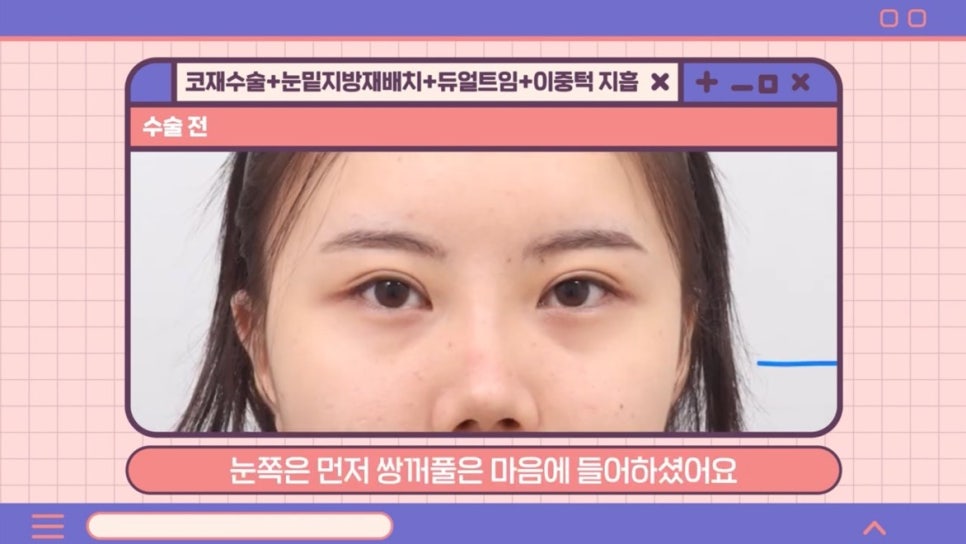 #AB Plastic Surgery #AB TV ##Case Review #Eye Surgery #Nose Revision Surgery image 1