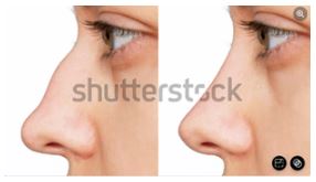 [Column] Is it possible to perform rhinoplasty for a male hump nose together with rhinitis surgery? image 2