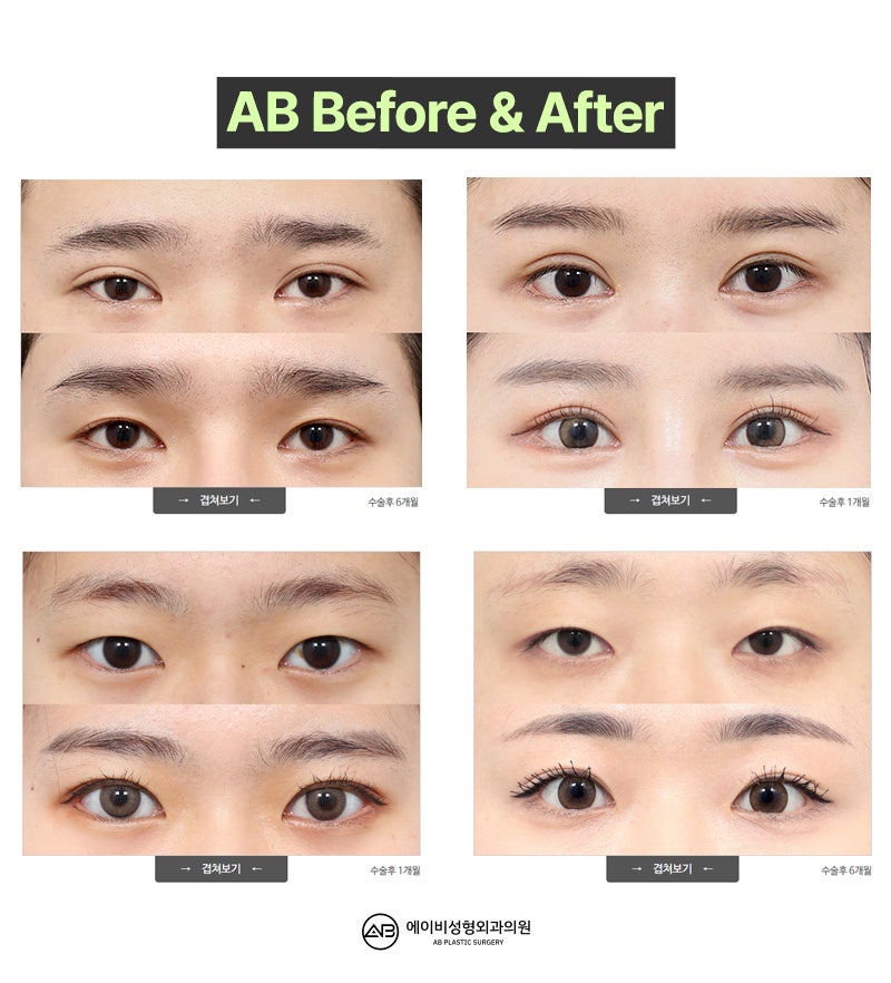 AB Revision Double Eyelid Surgery: What Is Double Folding? image 8