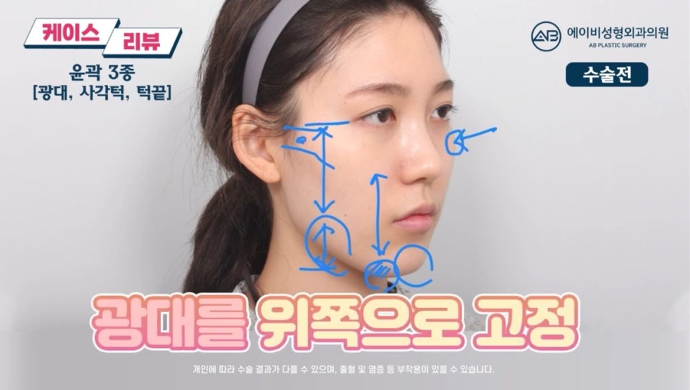 #에이비성형외과#에이비tv#케이스리뷰#안면윤곽성형 관련 이미지 2