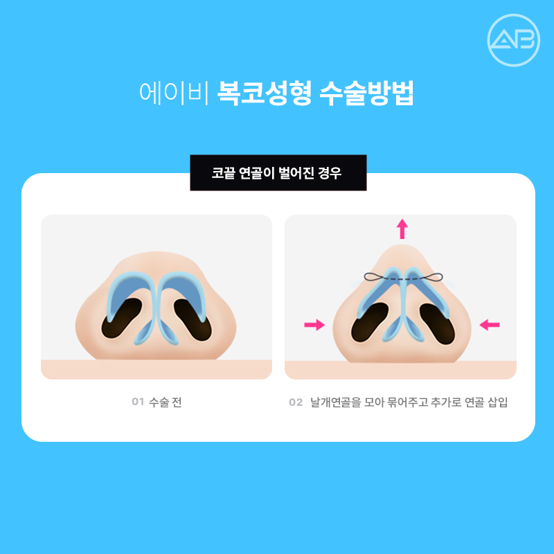 Why AB Plastic Surgery Is Famous for Bulbous Nose Surgery image 4