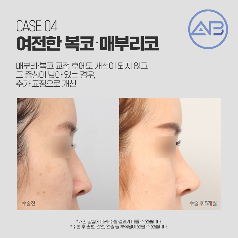 코재수술성형외과 에이비만 믿어! 관련 이미지 4