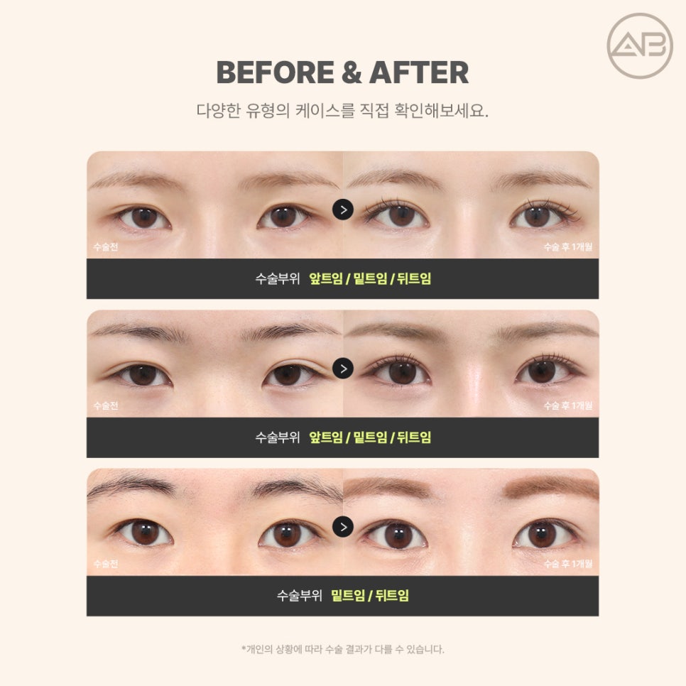 AB Plastic Surgery Eye Corner Surgery: Types and Reviews of Epicanthoplasty, Canthoplasty, and Lower Canthoplasty image 12
