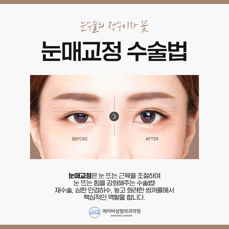 안검하수수술 부담없이 관련 이미지 2