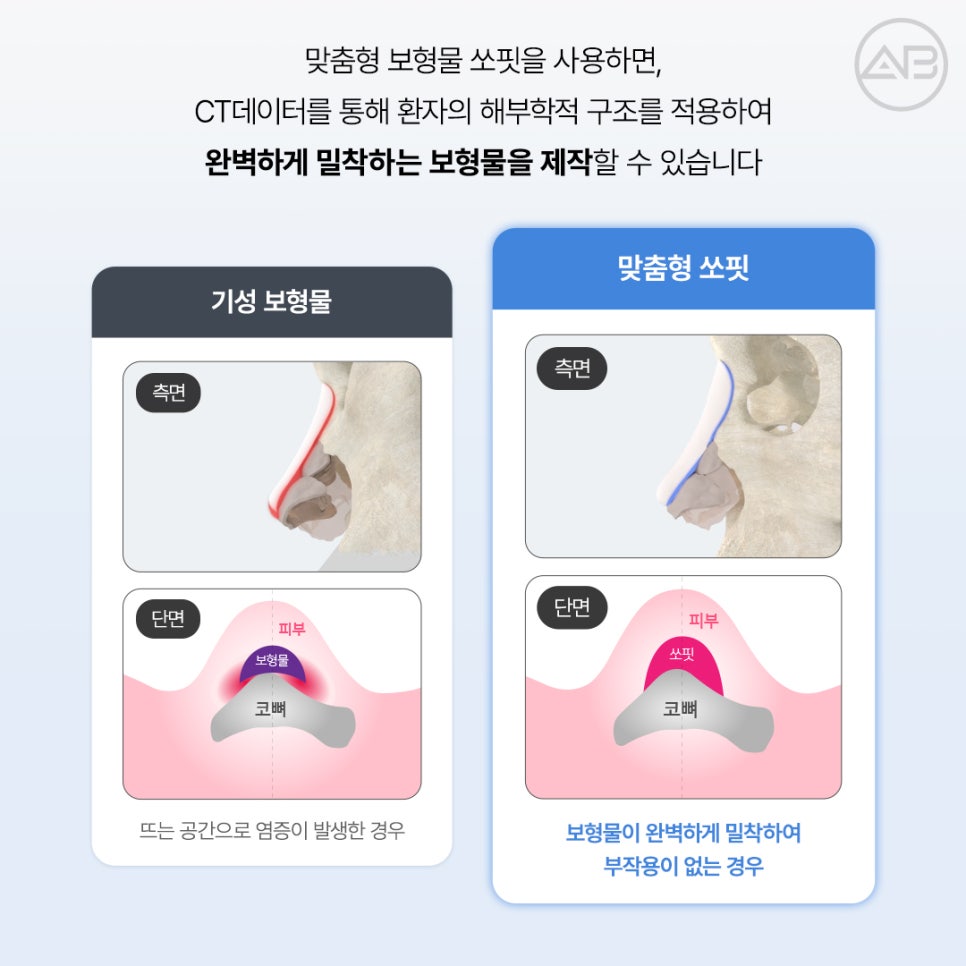에이비성형외과 쏘핏 (SOFIT) 3D 코성형보형물 비대칭 매부리 개선 관련 이미지 5