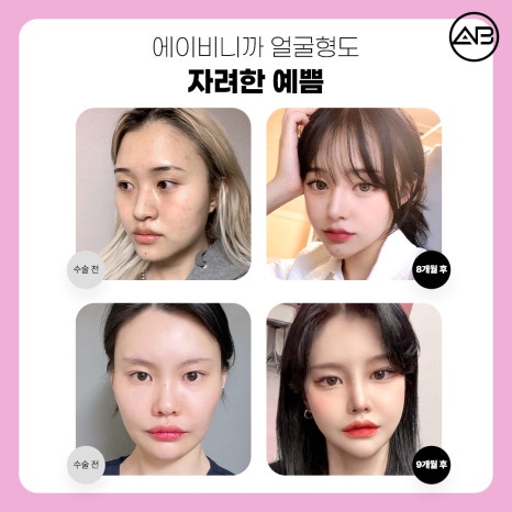자려한안면윤곽 원한다면 AB성형외과 관련 이미지 6