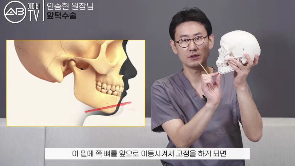 #AB성형외과#유튜브#에이비tv#앞턱수술#턱수술#윤곽수술 관련 이미지 5