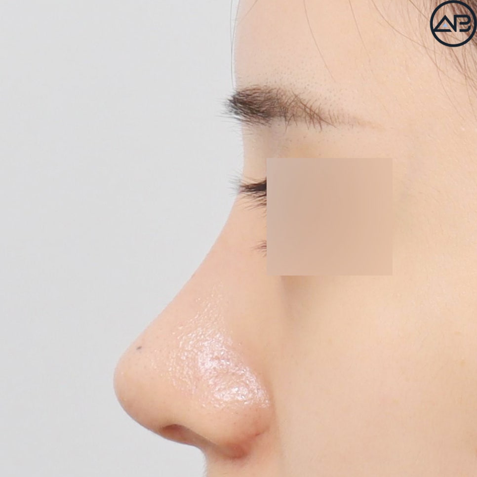 AB Plastic Surgery Refined Rhinoplasty - Revision Surgery Case Review image 7
