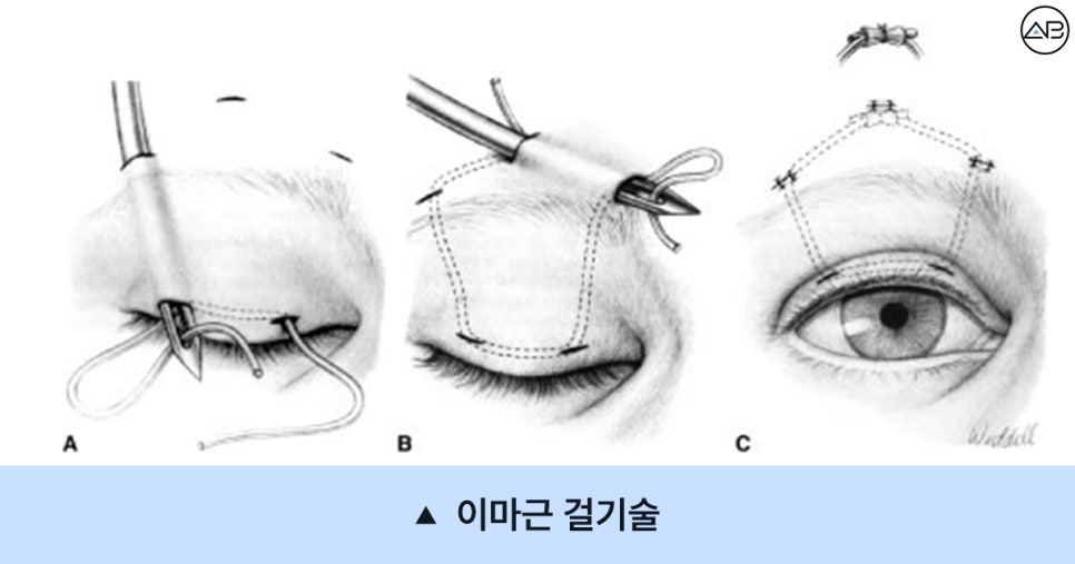 [눈매교정 하면 안되는 이유, 중증 안검하수의 진실] 관련 이미지 3