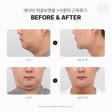 무턱성형 고려하고 있다면 AB성형외과 관련 이미지 8