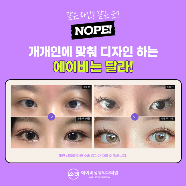 AB Plastic Surgery for First-Time Eye Surgery image 4