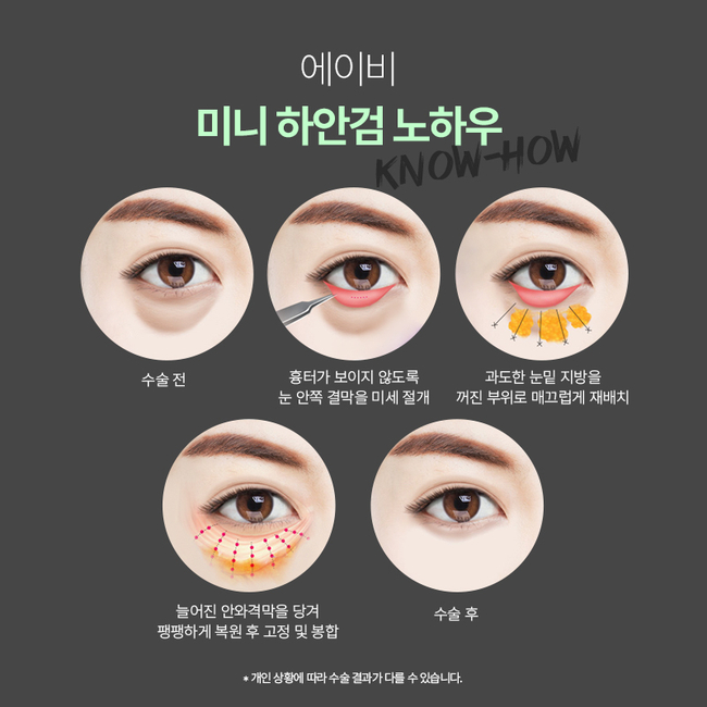 Differences in AB Plastic Surgery’s Mini Lower Blepharoplasty image 6