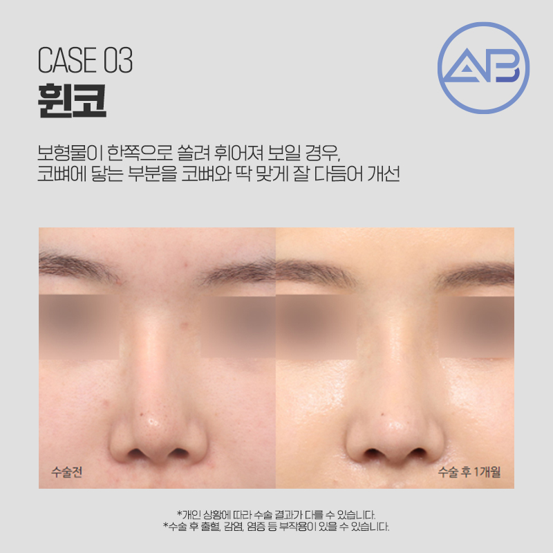 코재수술성형외과 에이비만 믿어! 관련 이미지 3