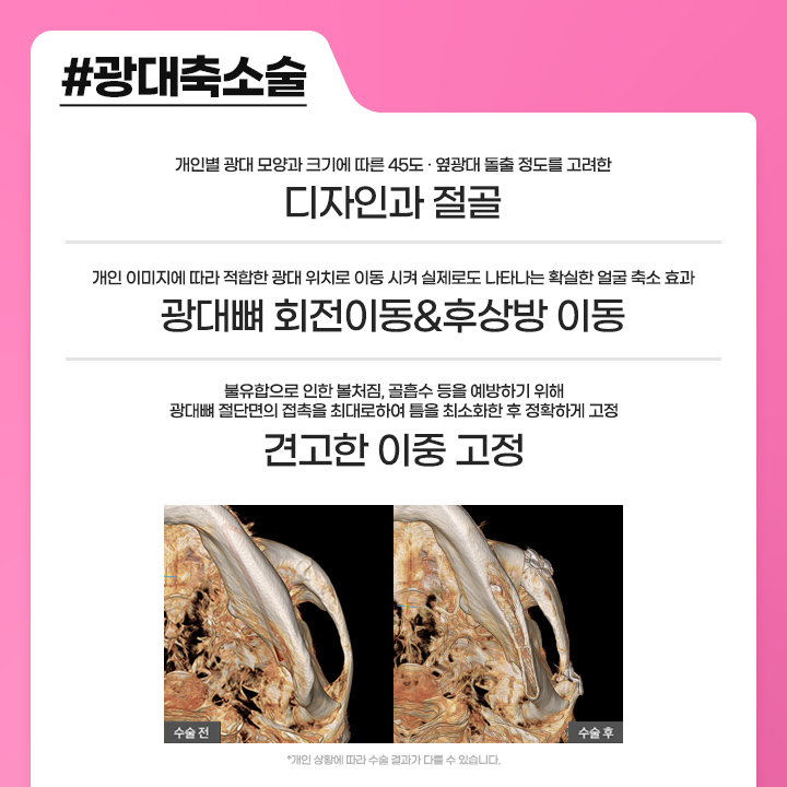 안면윤곽수술후붓기 때문에 걱정된다면 관련 이미지 2