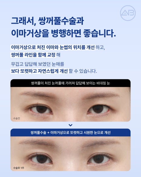 에이비성형외과 눈꺼풀처짐을 바꾸는 이마거상수술의 역할 알아보기 관련 이미지 3