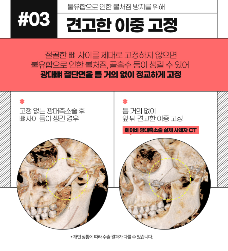 Experience Male Cheekbone Reduction Surgery at AB image 4