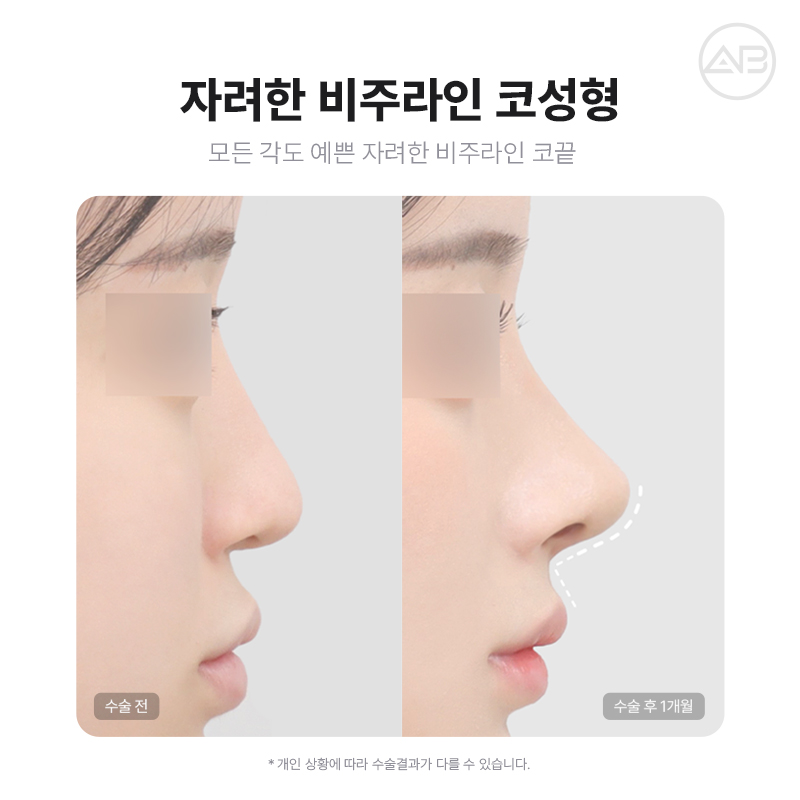 자려한비주라인코성형 AB성형외과에서 완성해보세요 관련 이미지 2